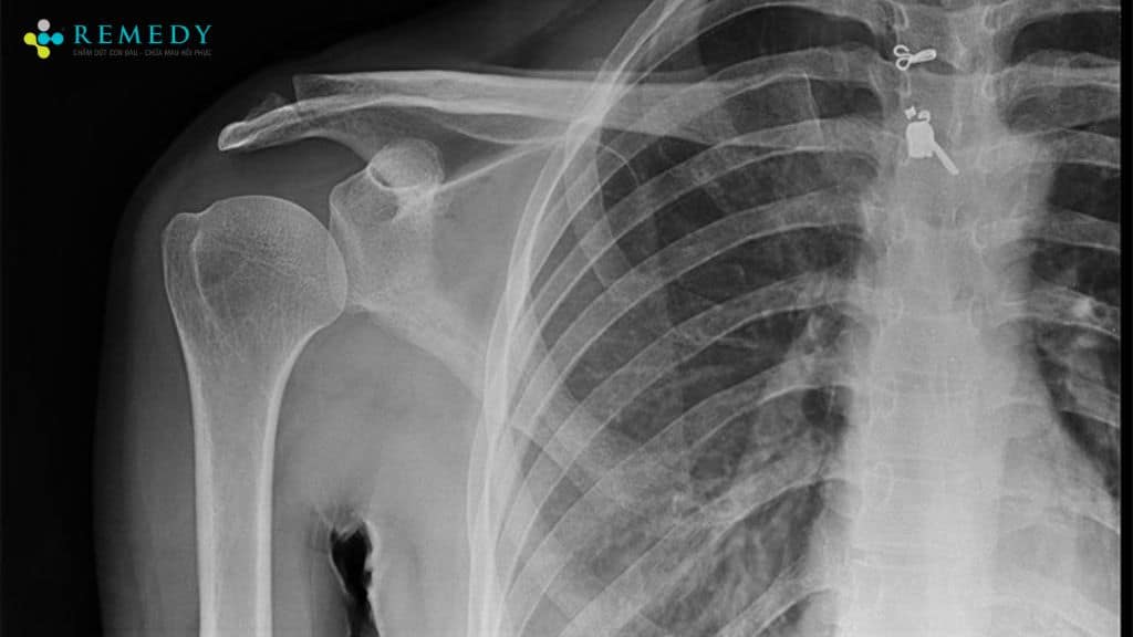 Chụp X-quang trong chẩn đoán rách chóp xoay vai ra sao?
