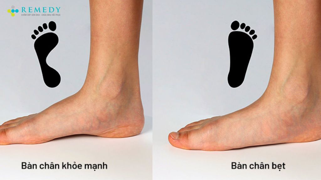 Bàn chân bẹt là gì?