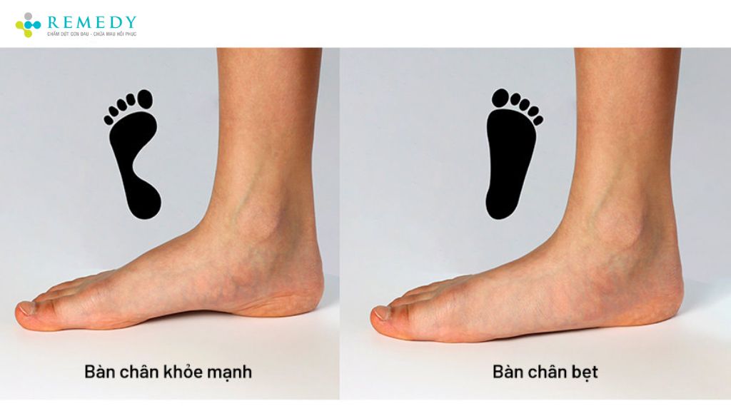 Hội chứng bàn chân bẹt ở người lớn
