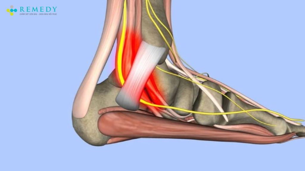 Hội chứng đường hầm cổ chân gây đau nhức cổ chân và bàn chân