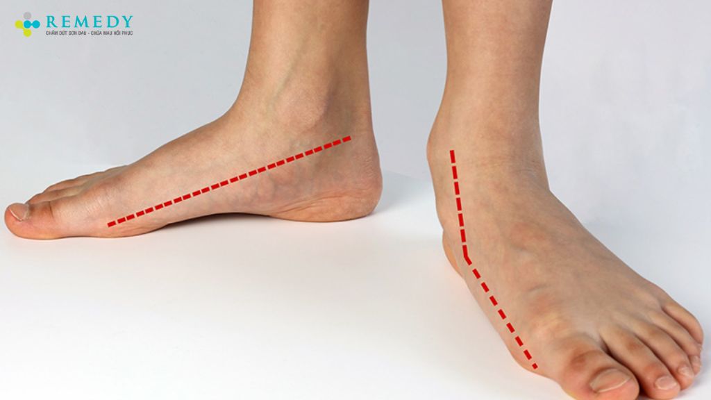 Lòng bàn chân không có độ hõm tự nhiên
