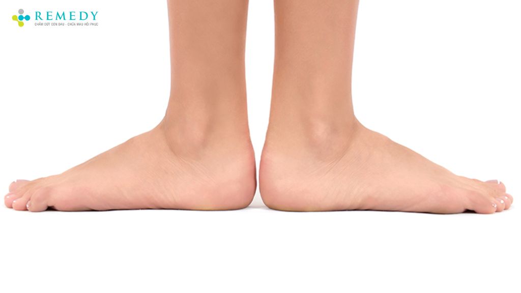 Nguyên nhân của hội chứng bàn chân bẹt