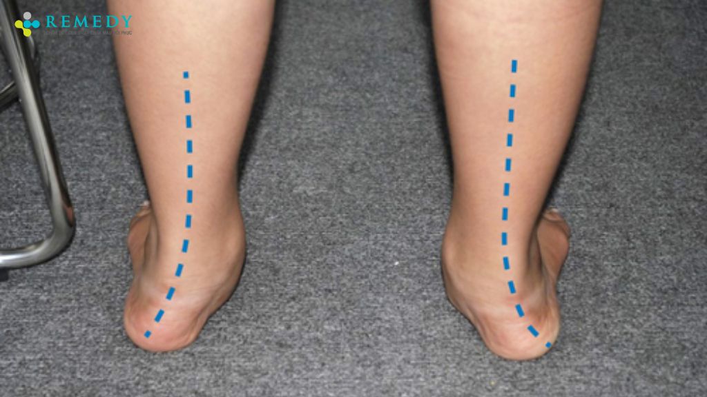 Triệu chứng bàn chân bẹt ở người lớn