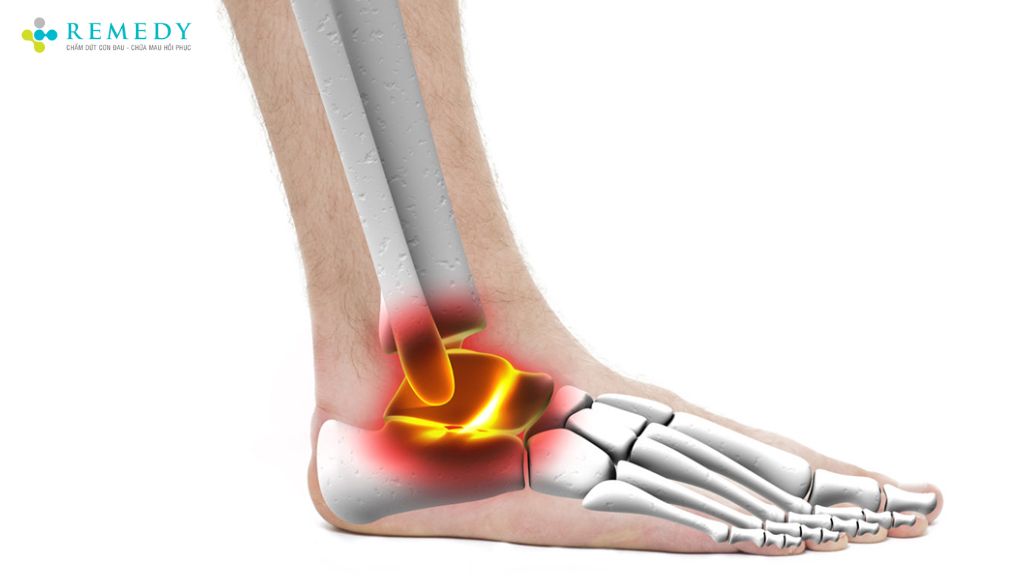 Yếu tố làm tăng nguy cơ mắc hội chứng đường hầm cổ chân